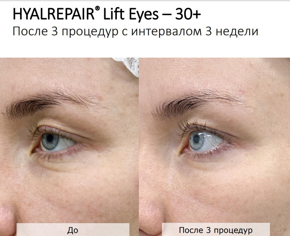 Hyalrepair Lift Eyes | ГК 12 мг/мл + Вит.С и Аминокислоты