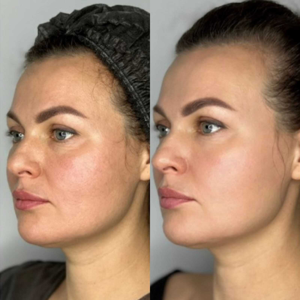 Rejusome | Сыворотка для омоложения кожи лица с экзосомами