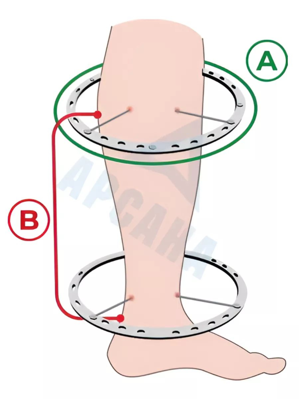 Чехол на аппарат внешней фиксации на голени, с открытой стопой. Ткань саржа, цвет изделия черный, цвет молнии черный. Размер GO-4