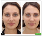 BioRePeelCl3 FND | Пилинг для лица