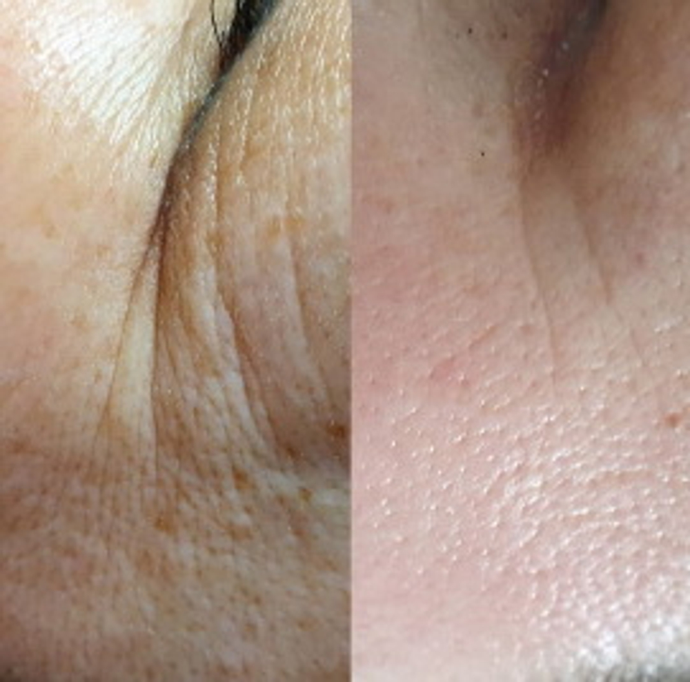 RelaxSim Ampoule Eldermafill | Пептидный миорелаксант