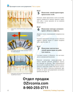 КОНТУРИРОВАНИЕ ПЕРЕДНИХ МОСТОВИДНЫХ ПРОТЕЗОВ