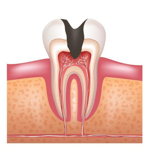 Лечение пульпита 1-канального зуба с постановкой постоянной пломбы( в несколько посещений)