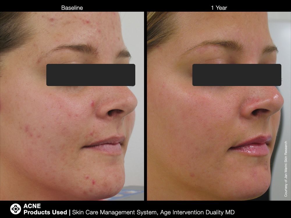 JAN MARINI AGE INTERVENTION DUALITY MD 0,9 % Крем-акселератор с ретинолом 0,9% для решения проблем возрастного акне