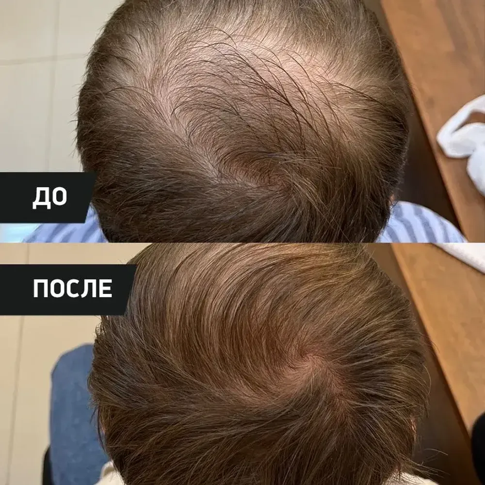 PERFOTESORO кислородная сыворотка для активного роста волос