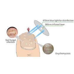 STELLAR BEAUTY RESEARCH Лазерное устройство для лечения ногтей