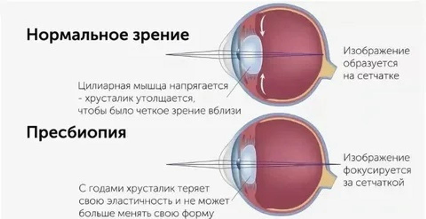 Современные решения для возрастного зрения