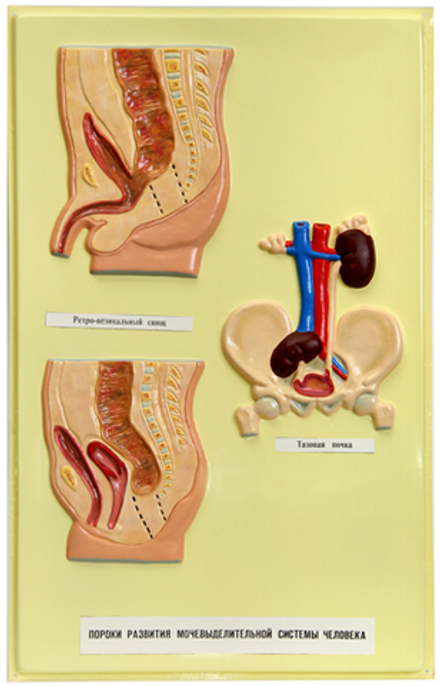 Барельефная модель "Пороки развития мочевой системы"