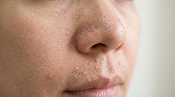 Комедондар: қара және ақ нүктелер — қалай жоюға болады және пайда болуын қалай болдырмау керек Комедондар: қара және ақ нүктелер — қалай жоюға болады және пайда болуын қалай болдырмау керек