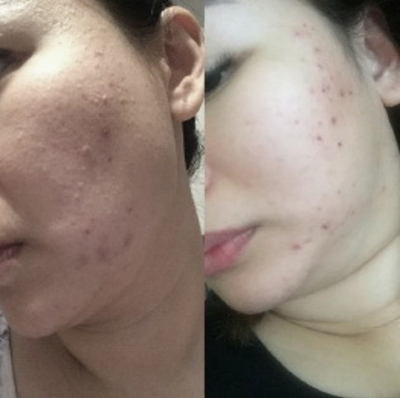 In-AC Ampoule Eldermafill | Терапия акне