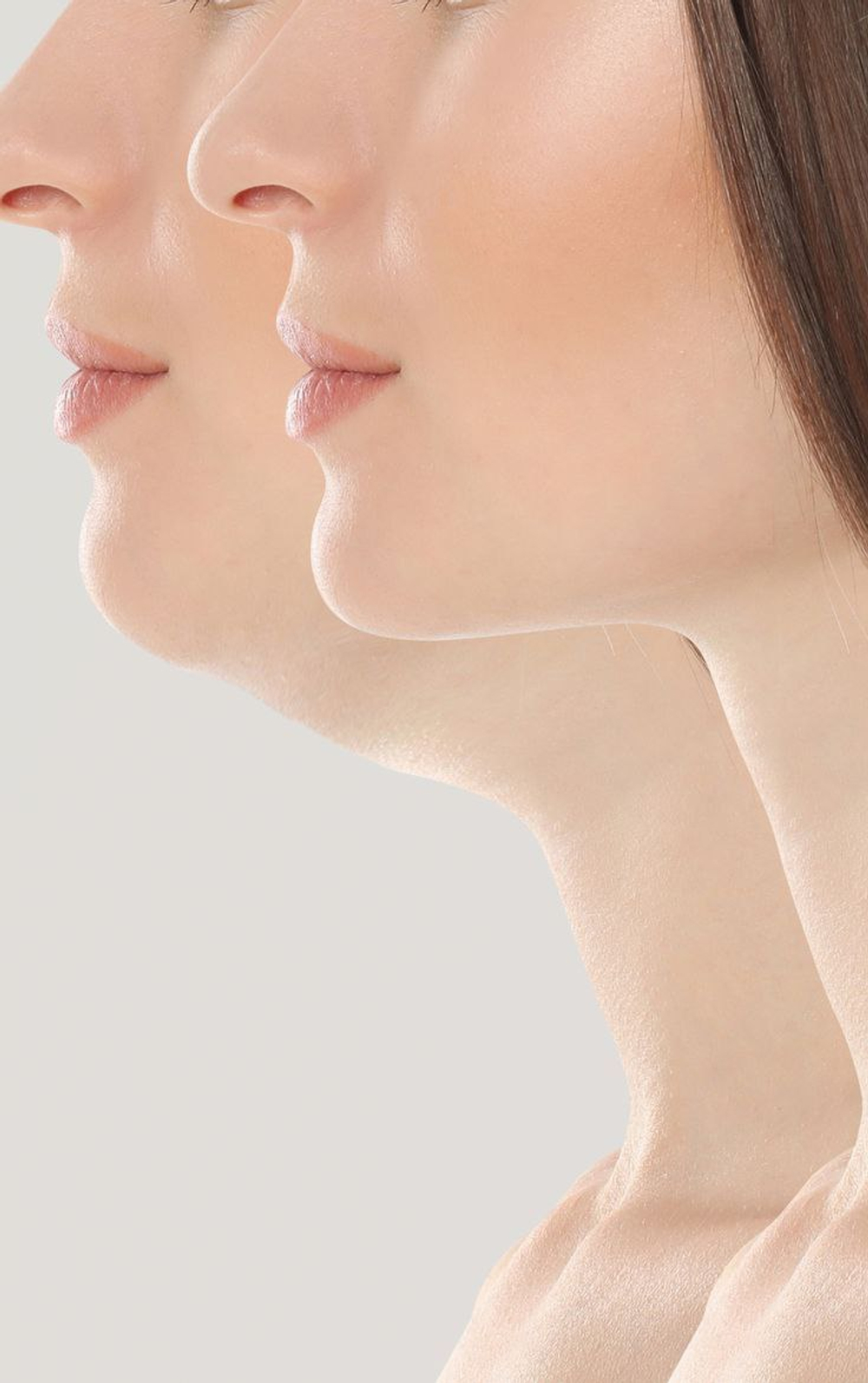 Французский лифтинг