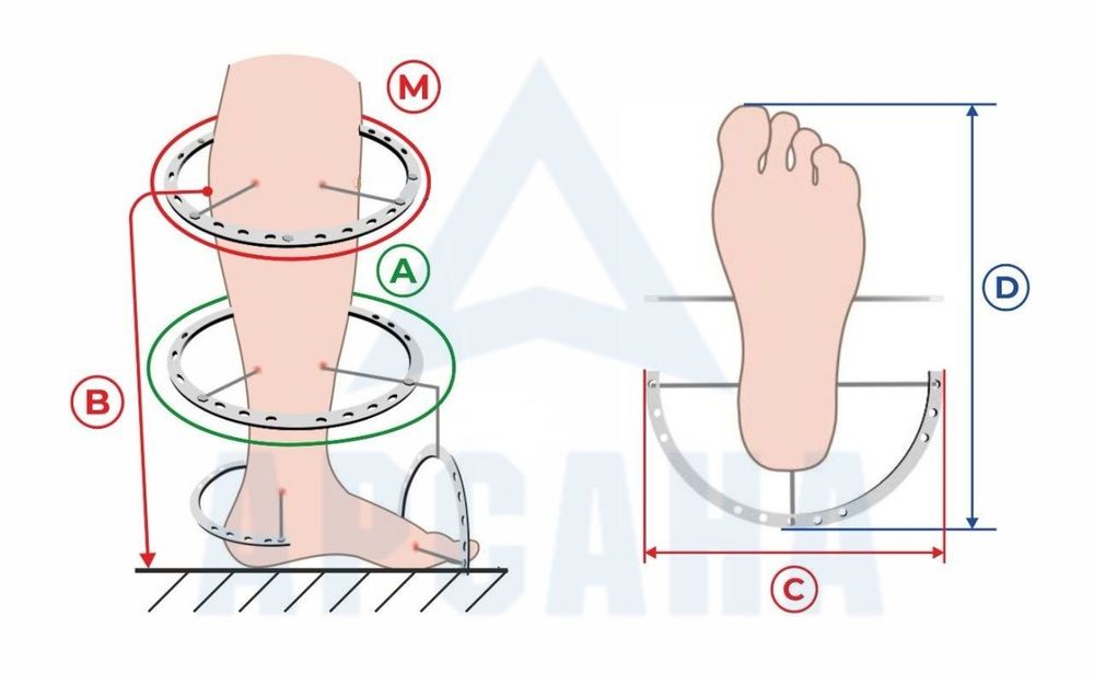 Чехол утепленный (до -10 С) с подошвой из резины на аппарат Илизарова на голени и стопе. ОГСРЗУ-6.
