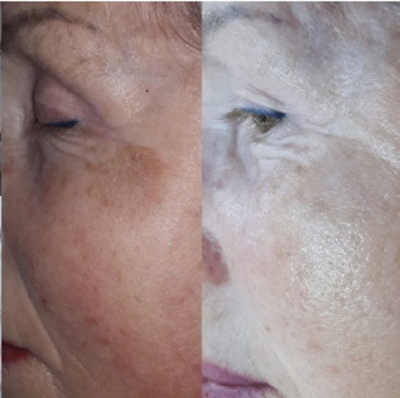 PDRN Rejuvenating Ampoule Eldermafill | Мощная регенерация