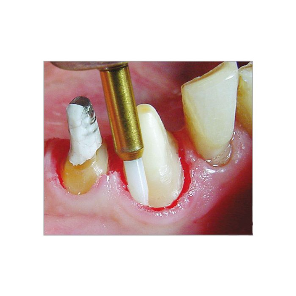 EDENTA STT250.314.016 Хирургический тканевый триммер для операции на мягких тканях полости рта STT250 FG, d 1,6 мм