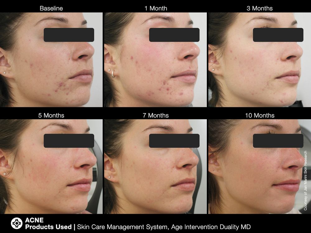 JAN MARINI AGE INTERVENTION DUALITY MD 0,9 % Крем-акселератор с ретинолом 0,9% для решения проблем возрастного акне