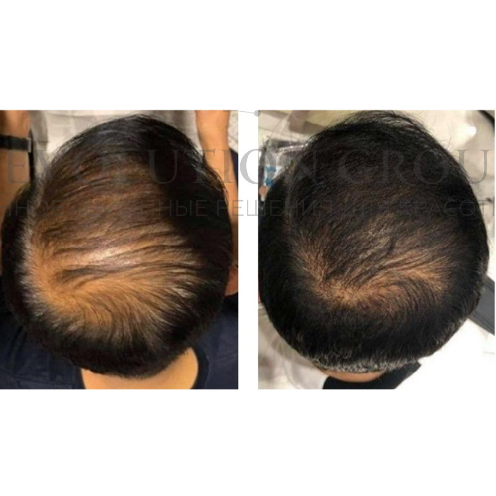 ASCE+ HRLV ExoCoBio | Лиофилизированный порошок экзосом для восстановления кожи головы и волос