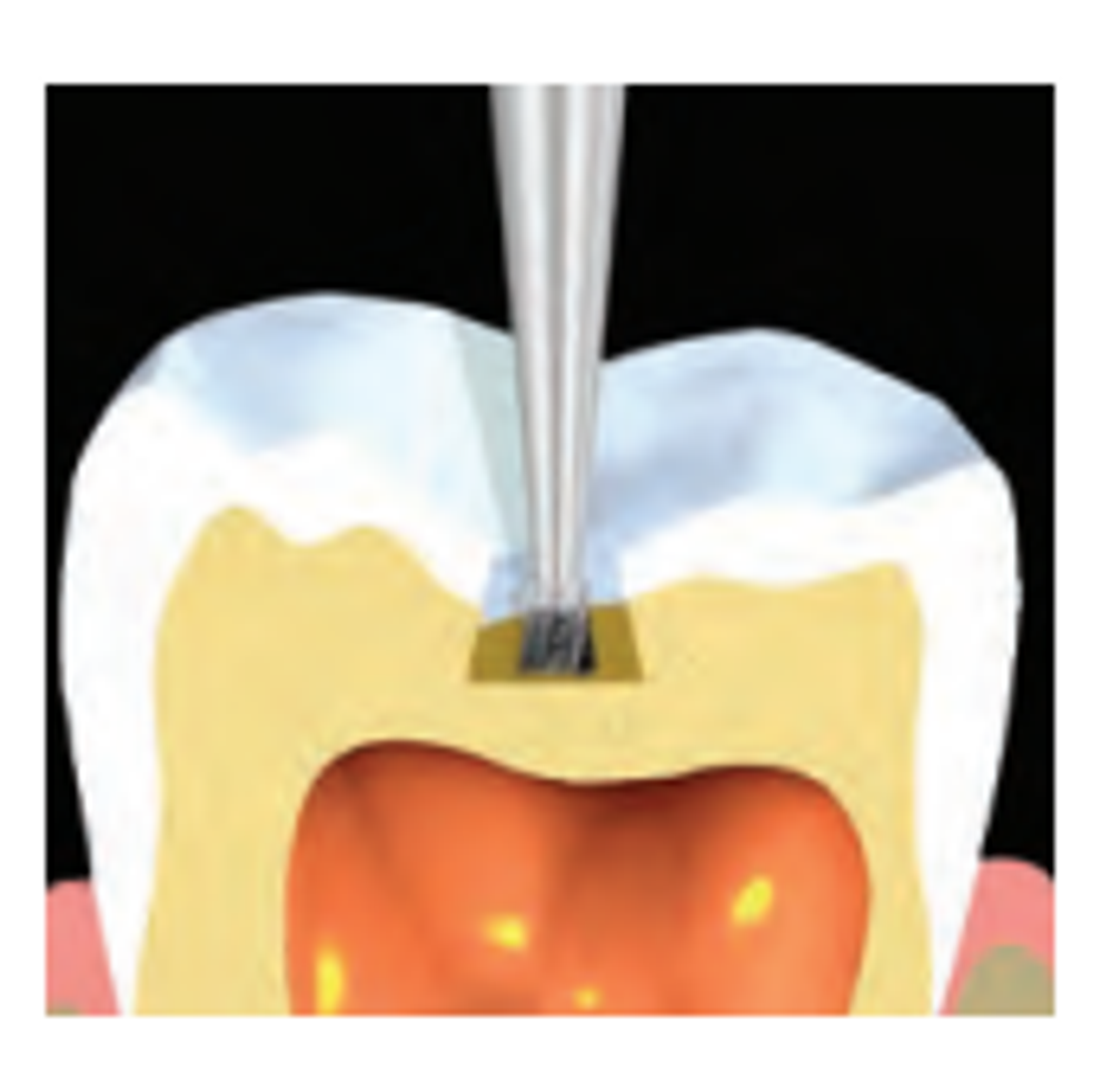 Бор твердосплавный Midwest - 163 FG 39