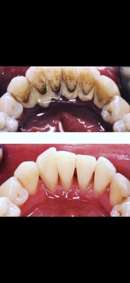 Профессиональная гигиена полости рта