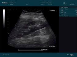 Аппарат УЗИ Edan DUS 60 (для гинекологии, стандартный)