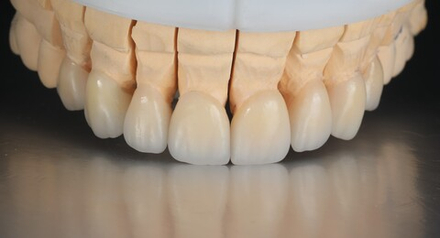 Коронка диоксида циркония (полная анатомия)