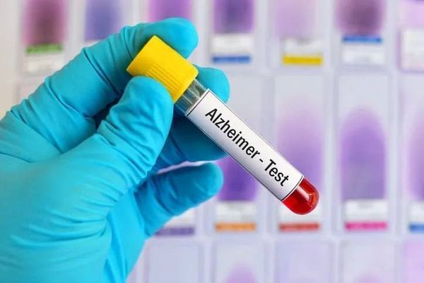 Исследователи выявили недостатки в многообещающих анализах крови для диагностики болезни Альцгеймера.