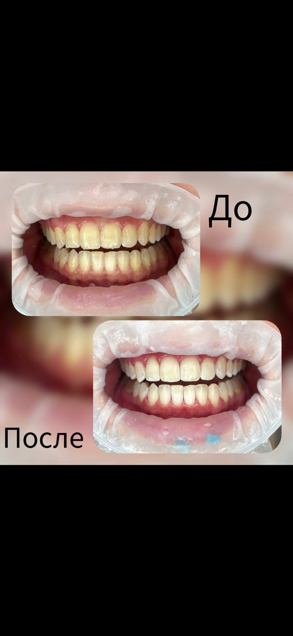Отбеливание