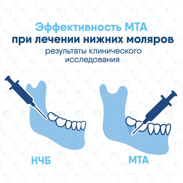 Эффективность МТА при эндодонтическом лечении нижних моляров с симптоматическим необратимым пульпитом: результаты рандомизированного клинического исследования