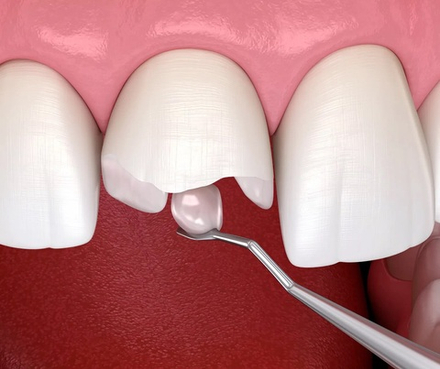 Реставрация зуба