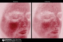 JAN MARINI ROSALIEVE Крем-акселератор для комплексного решения проблем розацеа