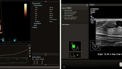 Аппарат УЗИ Philips EPIQ Elite