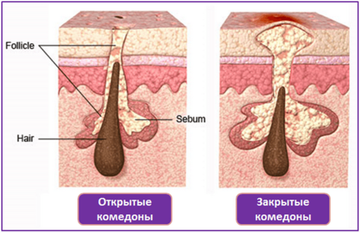 Закрытые комедоны: инструкция по ликвидации