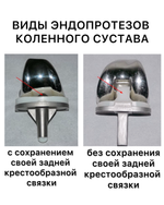 Эндопротез коленного сустава виды