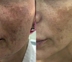 PDRN Glutathione Ampoule Eldermafill | Сияние и реструктуризация