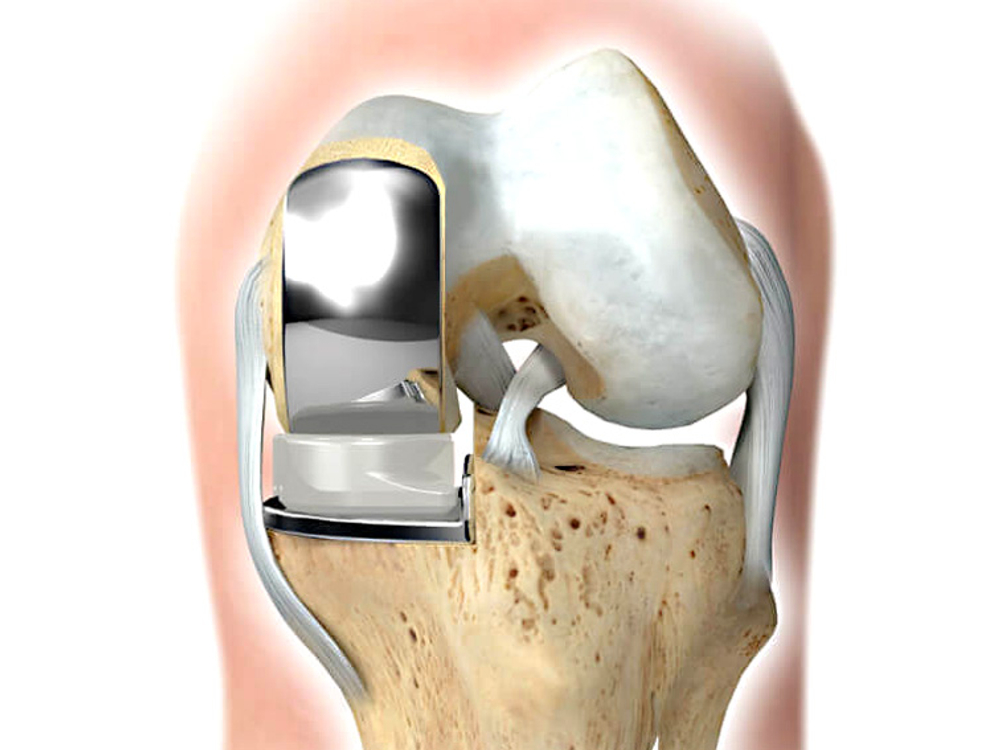 Частичное эндопротезирование коленного сустава