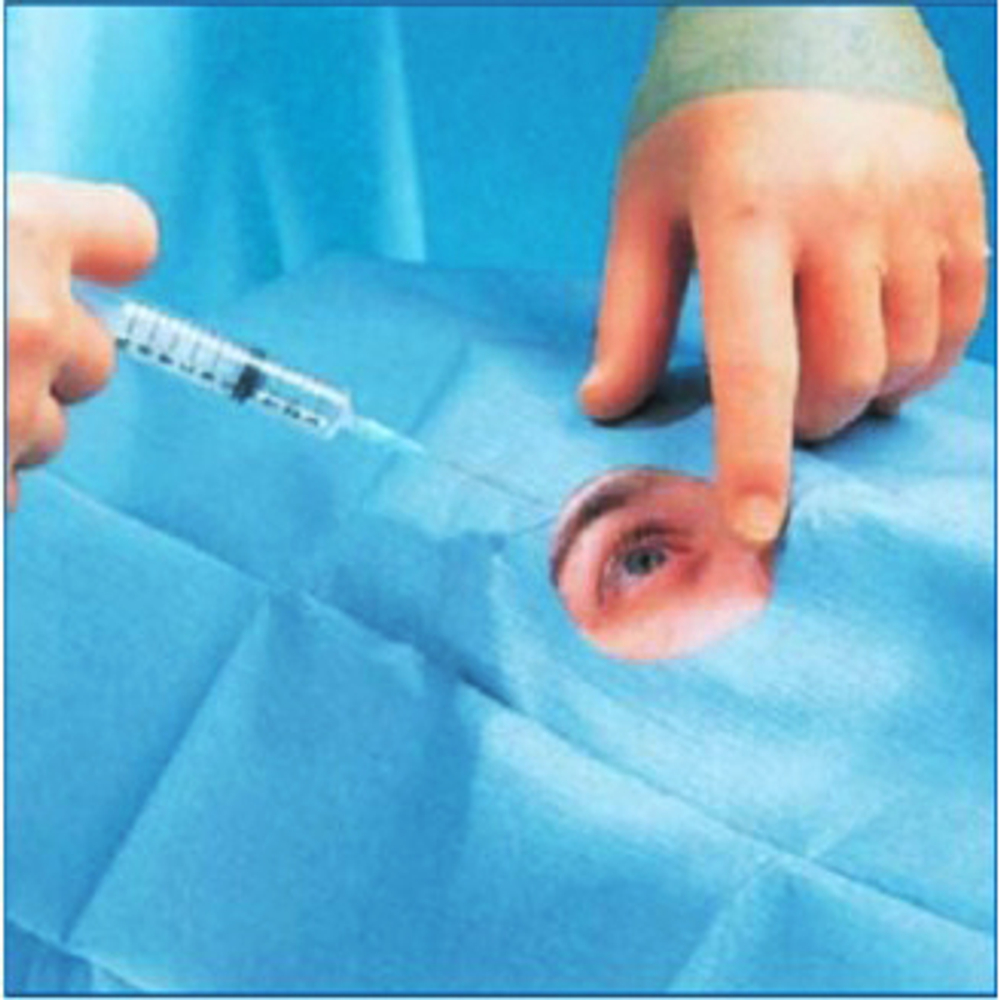 Простыня офтальмологическая 1,2 ⨯ 0,8 м с отверстием стерильная Инмедиз