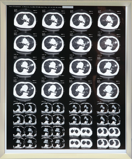 Негатоскоп на 1 снимок медицинский светодиодный