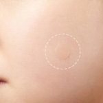 Наклейки против прыщей Elizavecca Witch Piggy Hell-Pore Blemish Spot Patch