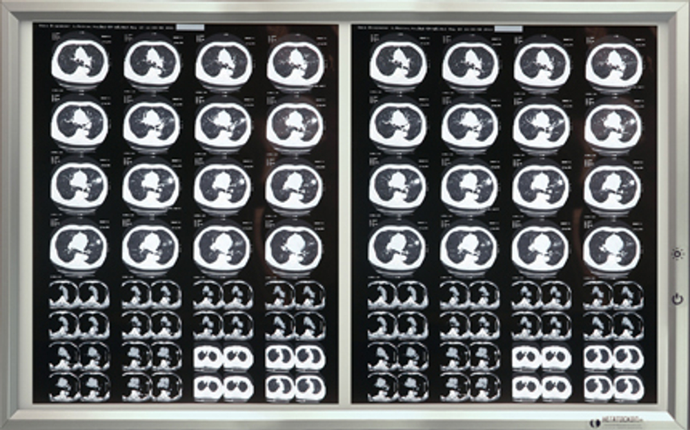 Негатоскоп на 2 снимка медицинский светодиодный