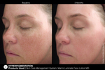 JAN MARINI LUMINATE FACE LOTION MD, 0,75% Крем-акселератор с ретинолом 0,75% для борьбы с пигментацией