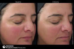 JAN MARINI ROSALIEVE Крем-акселератор для комплексного решения проблем розацеа