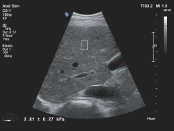 Аппарат УЗИ Philips Affiniti 70