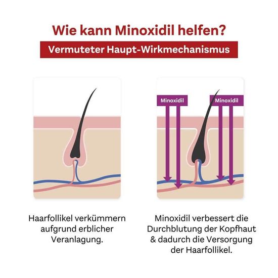 Minoxidil Doppelherz 3*60 ml