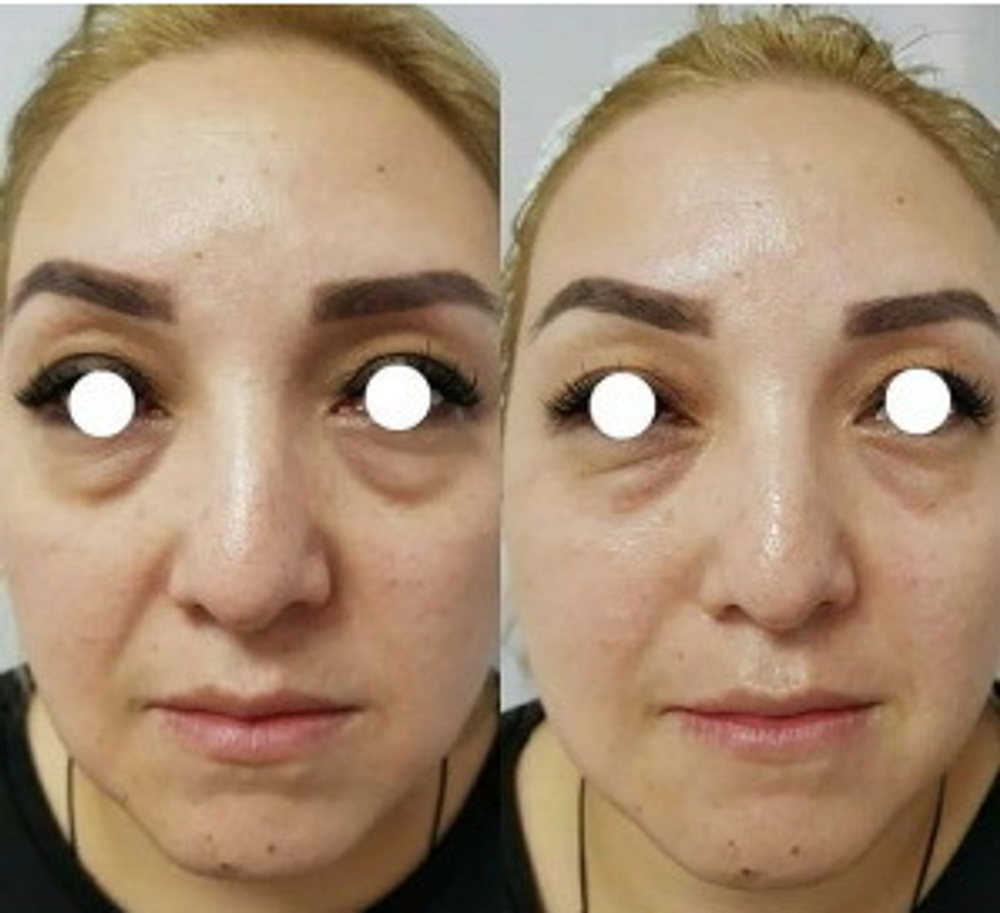 PDRN Booster Eldermafill | Усилитель мезотерапии