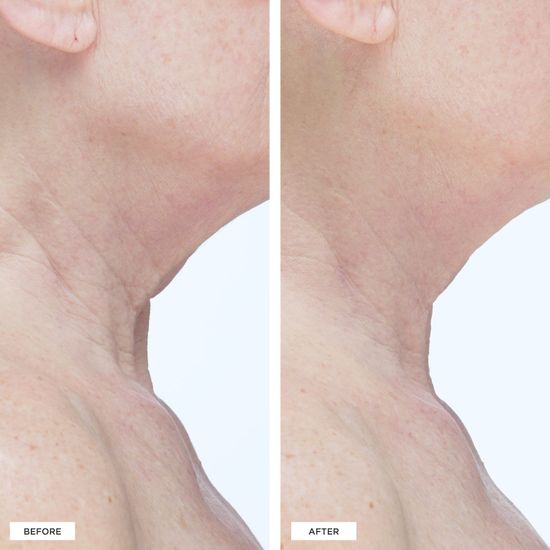 Лифтинг крем для лица, шеи и подбородка Perricone MD Cold Plasma Plus+ Sub-D/Neck 