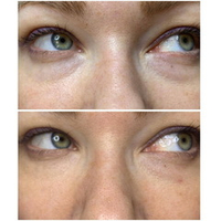 Anti-Bag Solution Evasion | Мезококтейль от мешков под глазами