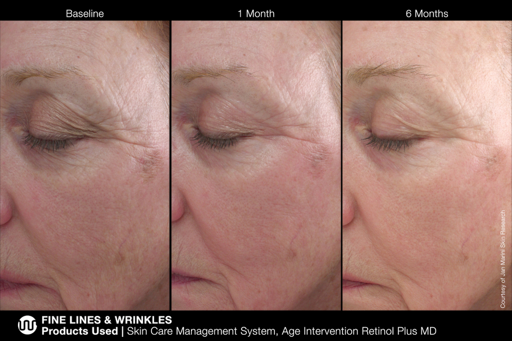 MARINI SKINSOLUTIONS AGE INTERVENTION RETINOL PLUS XC 1% Крем-акселератор с ретинолом 1% для борьбы с видимыми возрастными изменениями