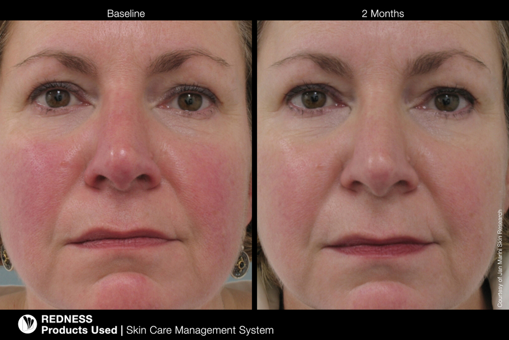 JAN MARINI SKIN CARE MANAGEMENT SYSTEM (NORMAL-COMBO) SPF33