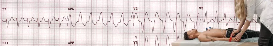 Что такое электрокардиография (ЭКГ) сердца? Регистрация и исследование электрической активности сердечной мышцы