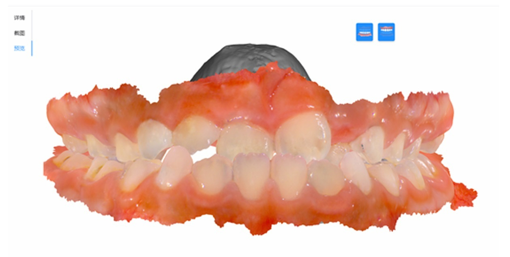 Интраоральный 3D сканер MaxFlex