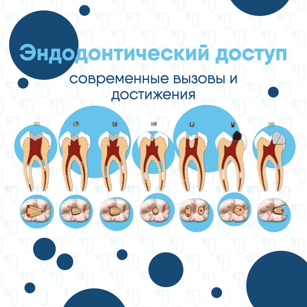 Эндодонтический доступ: современные вызовы и достижения Эндодонтический доступ: современные вызовы и достижения